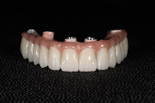 Will I Need A Bone Graft For The All On   Procedure?