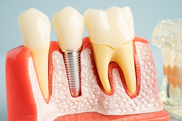 Can Dental Implants Replace Molar Teeth?