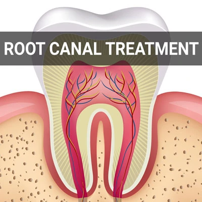 Visit our Root Canal Treatment page